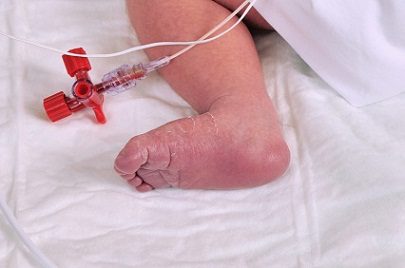 Baby foot-hospital 1-31-12 (2)