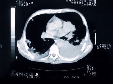 Lung Cancer Screening Would Save Lives at Relatively Low Cost