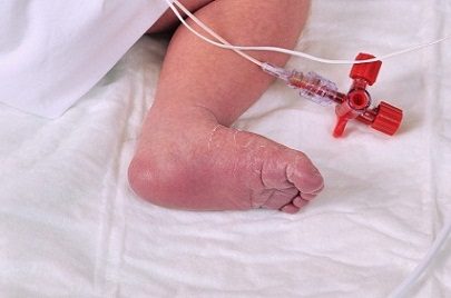 Baby foot-hospital 5-1-12 (2)