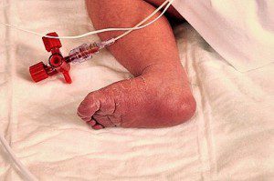 Baby foot-hospital 1-13-16